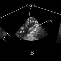 Which is the proper syllabic breakdown for the word catheter