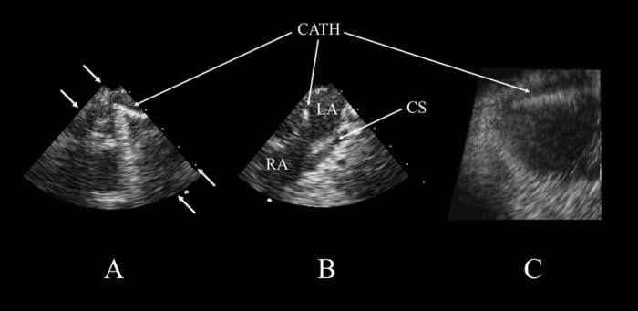 Which is the proper syllabic breakdown for the word catheter